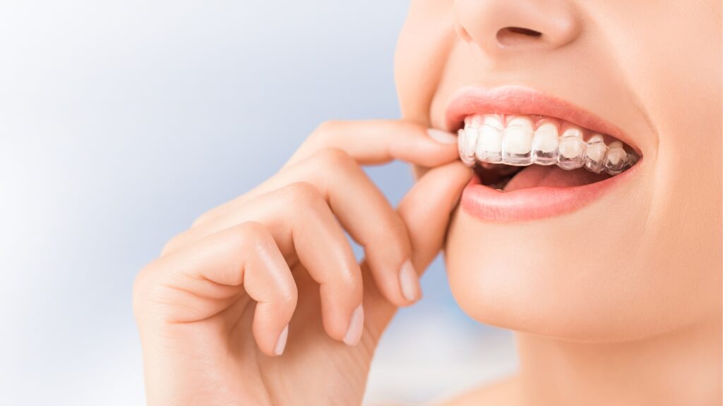 Aligners Treatment image