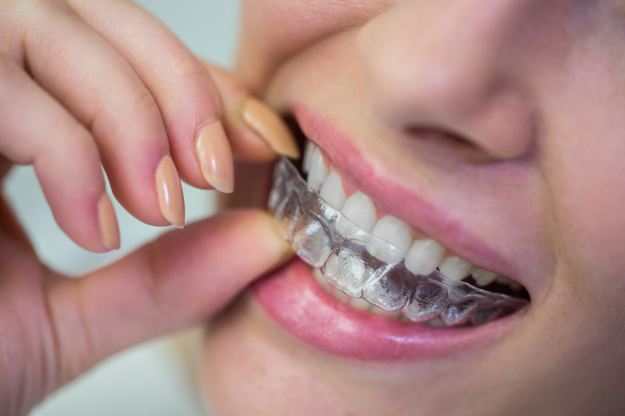 Aligners Image